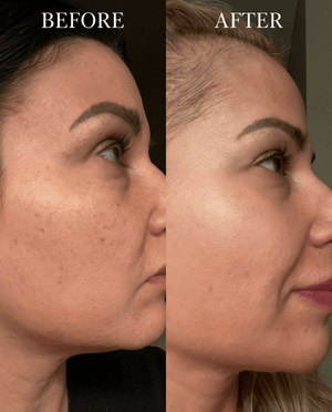 Dream skin - Before and after results