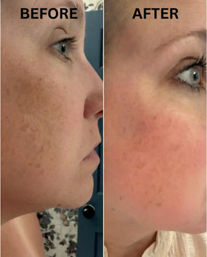 Before and after using niacinamide moisturizer — visibly faded dark spots in 8 weeks