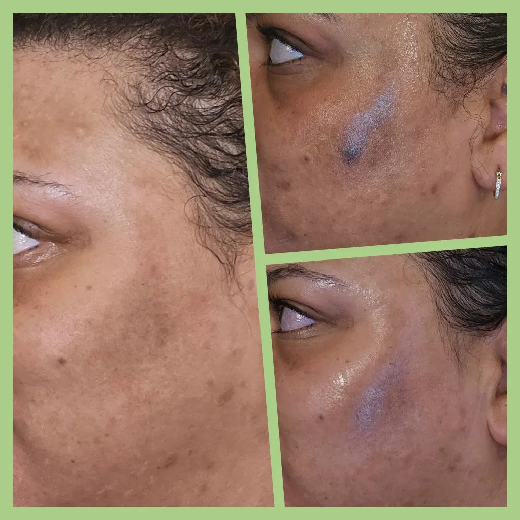 Before and after using Gentle Renewal Exfoliating Pads — brighter, more even tone